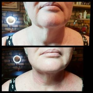 HIFU – THE MUST HAVE TREATMENT FOR JOWLS!