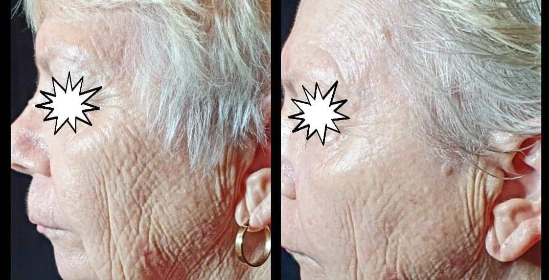 Old woman anti aging before and after skin therapy