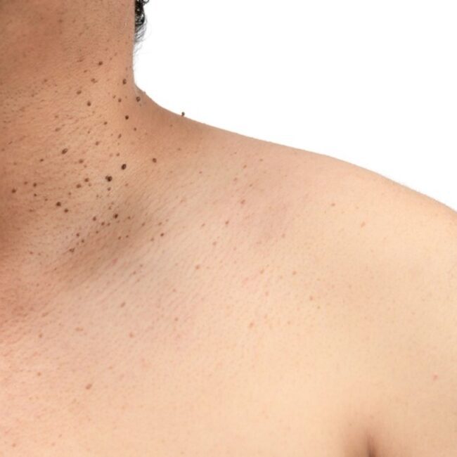 Skin with moles before Clear Skin Treatment